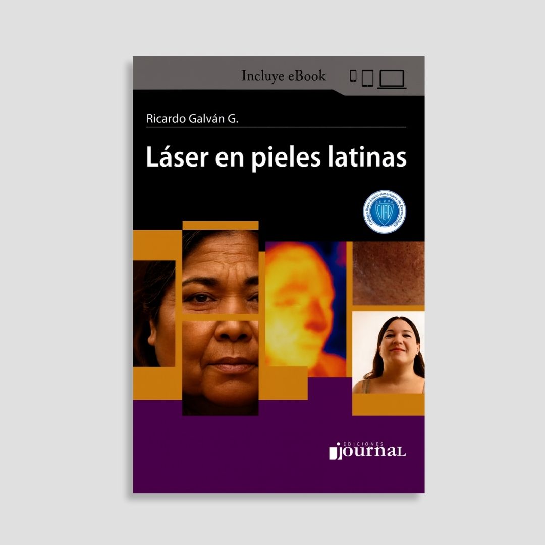 Láser en pieles latinas
